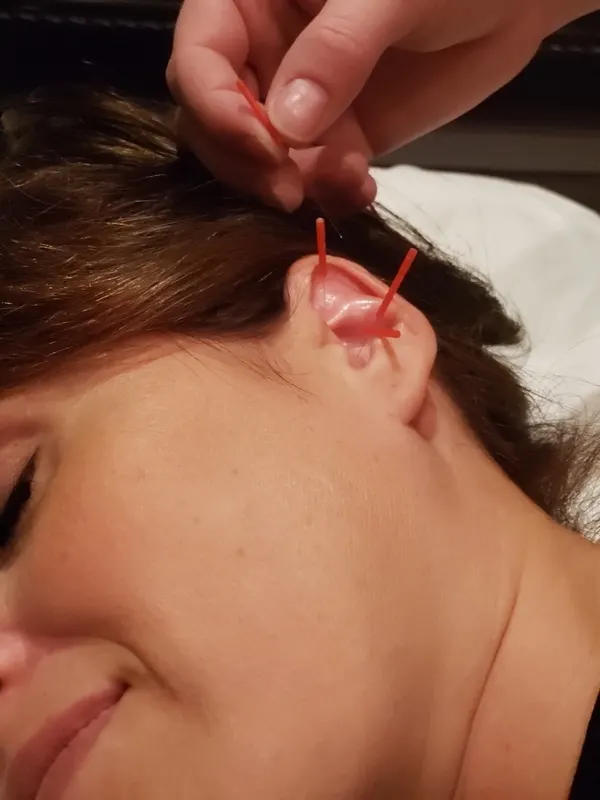 Acupuncture treatment